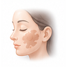 Melasma