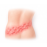 Shingles
